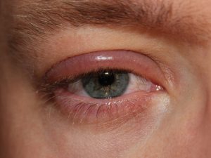 Accent Eye Care 1024px-Blepharitis  