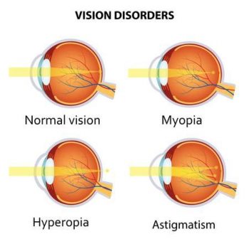Accent Eye Care Myopia  