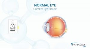 Accent Eye Care video_cover-normal_eye  