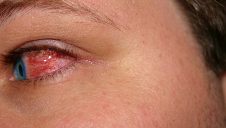 Accent Eye Care Eye Color - Understanding Iritis  