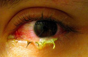 Accent Eye Care Swollen_eye_with_conjunctivitis  