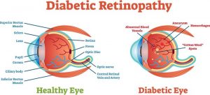 Accent Eye Care Diabetic Retinopathy_1  