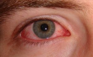 Accent Eye Care eye infection  