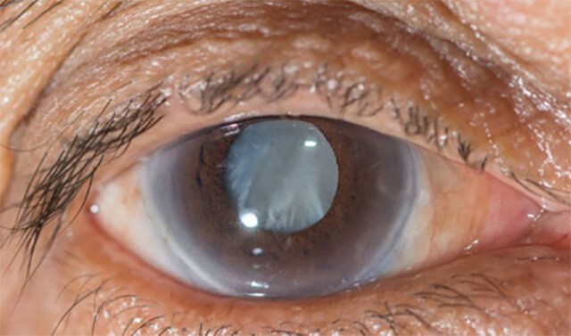 Accent Eye Care What are Cataracts?  