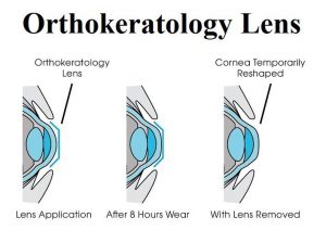 Accent Eye Care OrthoK  