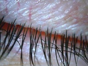 Accent Eye Care blepharitis after  