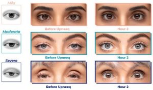 Accent Eye Care Upneeq-before-after-img  