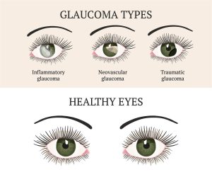 Accent Eye Care Glaucoma Chart  