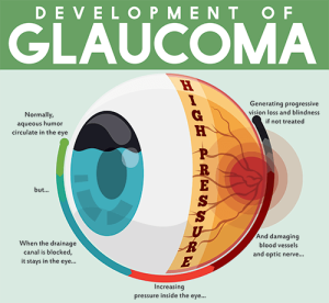 Accent Eye Care glaucoma diagram  